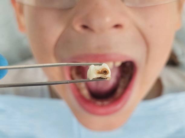 Best Emergency Wisdom Tooth Extraction in Larchmont, NY